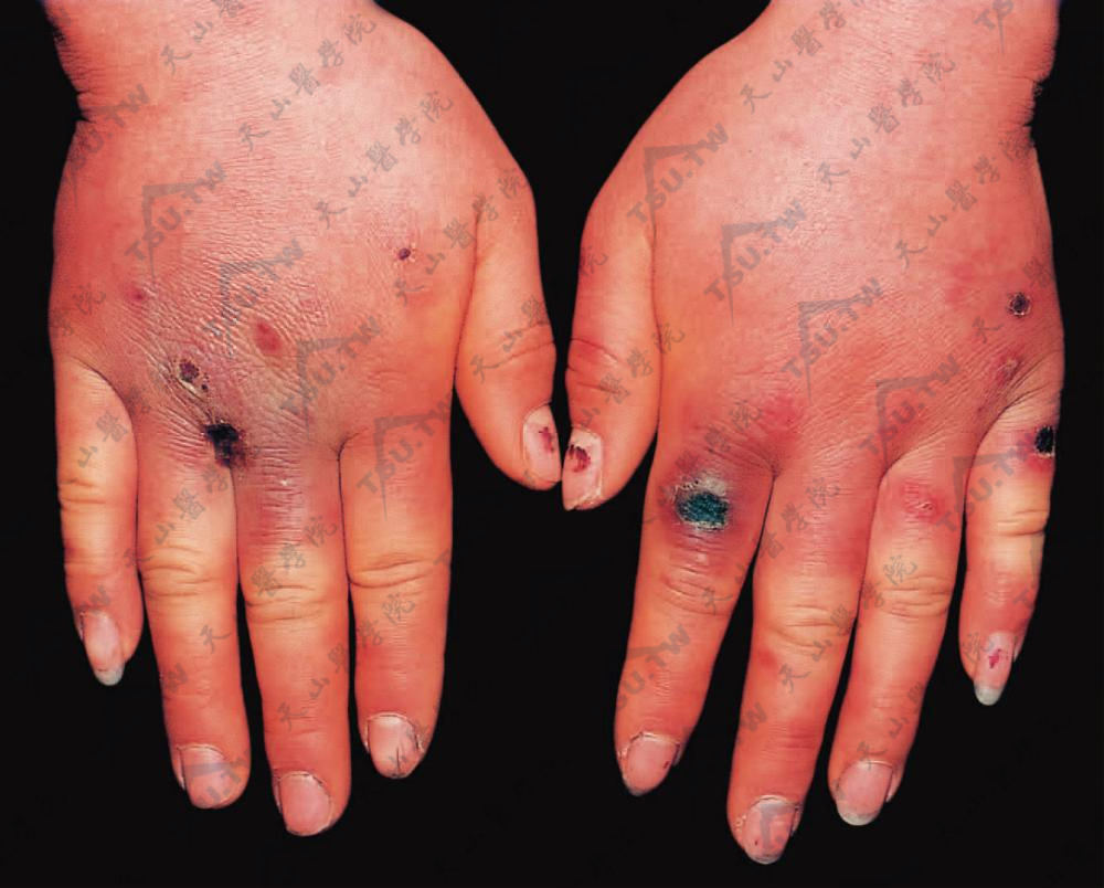 冻疮：两手指背部及手背有多个局限性暗紫红色水肿性红斑，境界不清，边缘鲜红色。有的已发生糜烂或溃疡