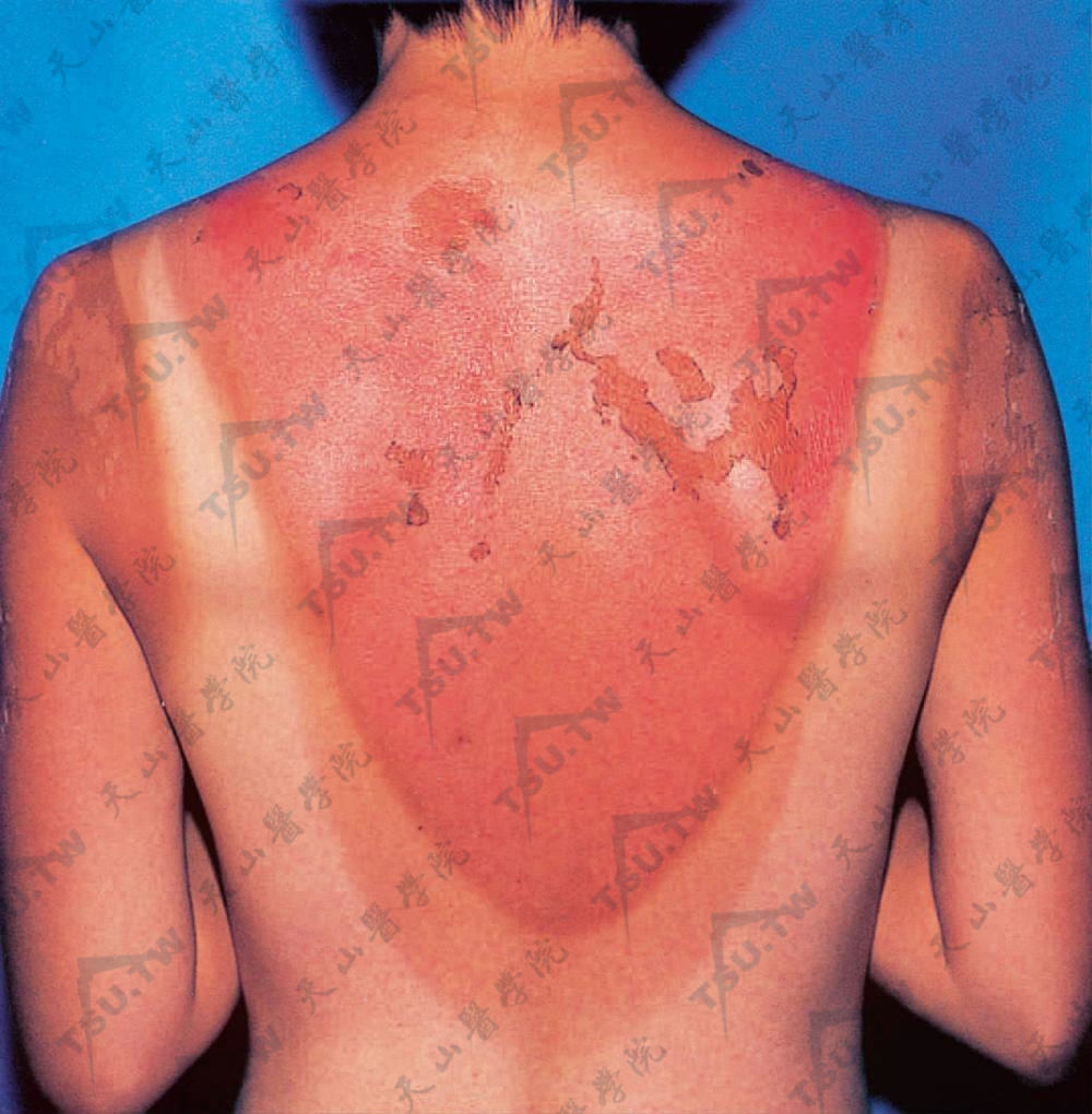 晒伤：露出部位的皮肤上发生弥漫性水肿性红斑