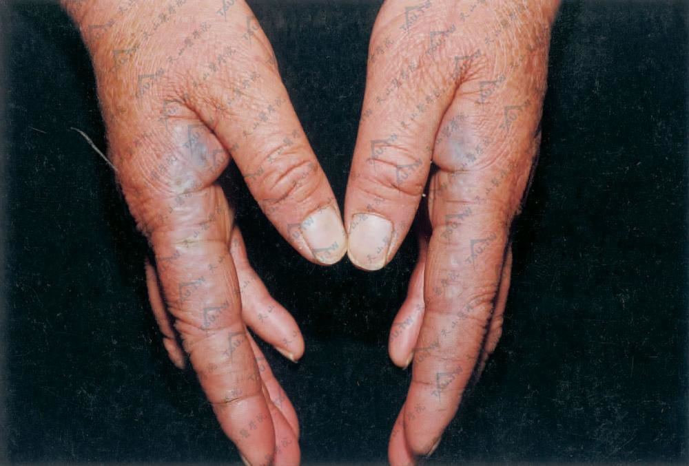 双手示指外缘线状排列淡蓝色扁平丘疹，皮肤中央可见凹陷，双手拇指指甲淡蓝色