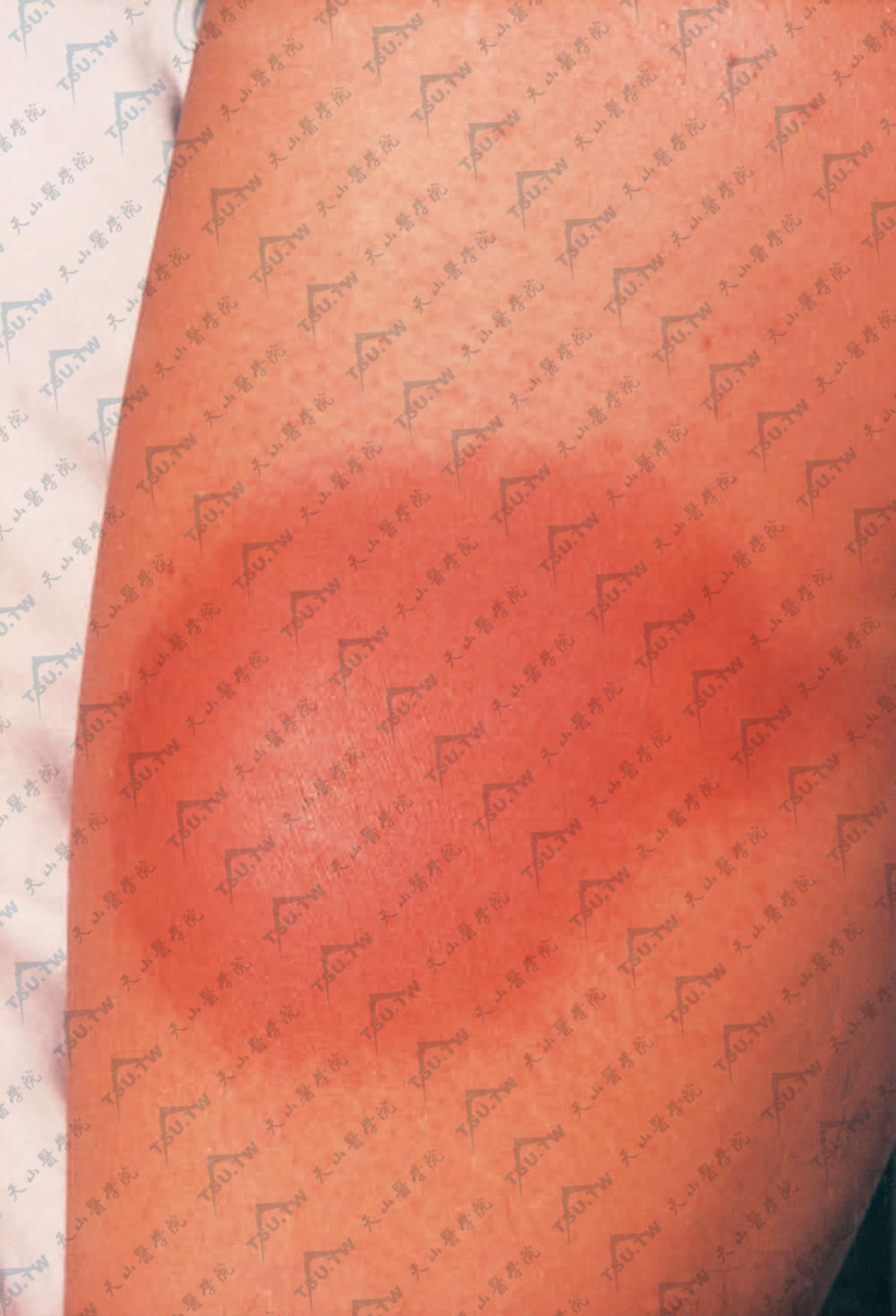 急性放射性皮炎（Acute Radiodermatitis）