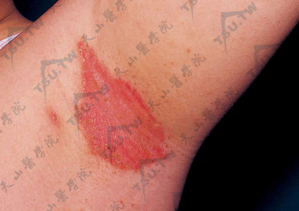 摩擦红斑：腋窝皱襞处潮红肿胀，境界清楚，有轻度糜烂