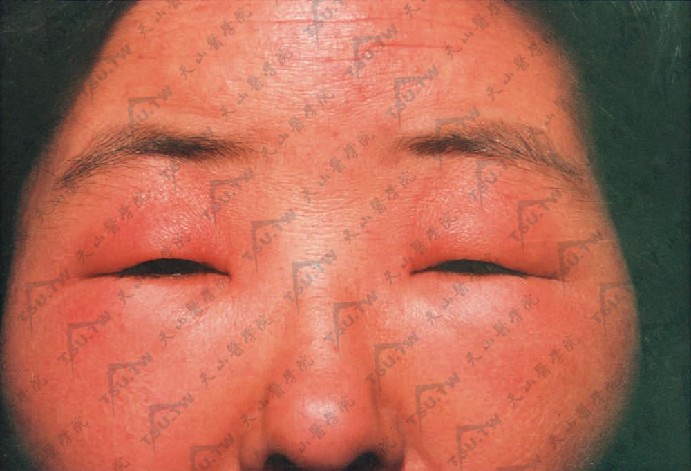 对染发剂过敏致面部红肿，尤以眼睑为甚，眼裂变小