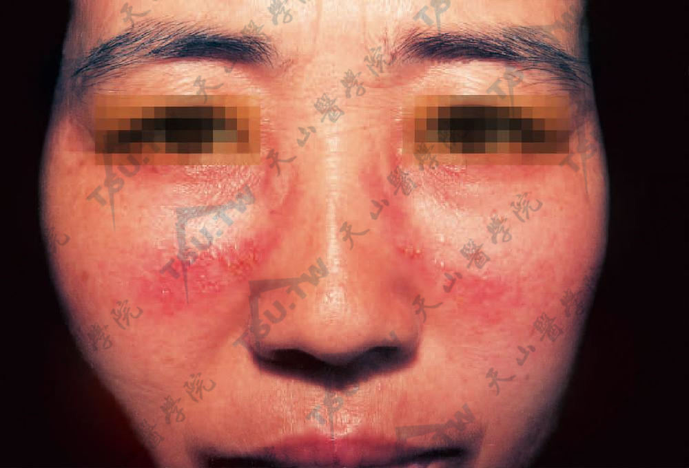 过敏接触性皮炎：面颊部接触眼镜框处，可见弧形红斑上密集丘疹及丘疱疹