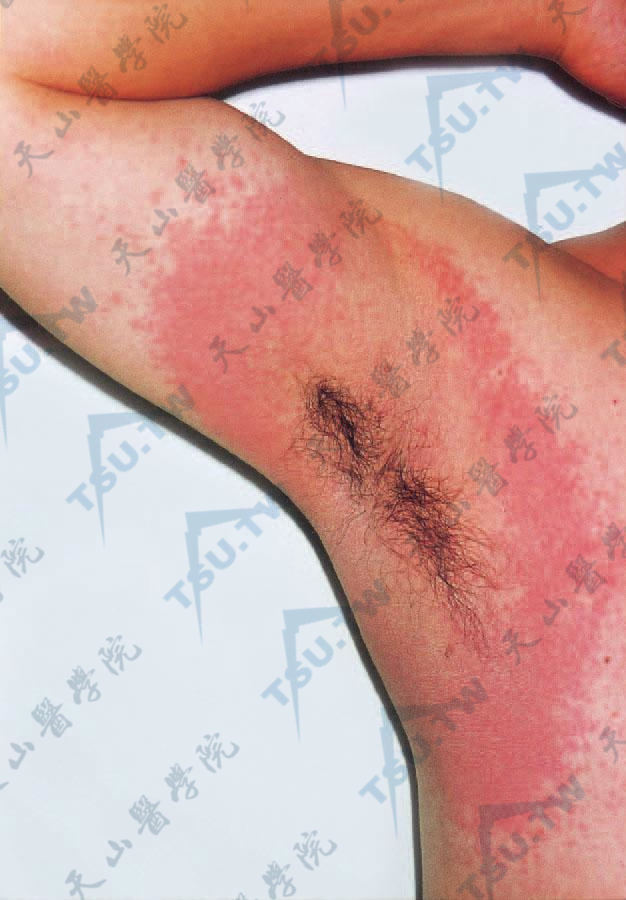 过敏接触性皮炎：因腋臭外敷半月清后，局部发生红斑、小水疱