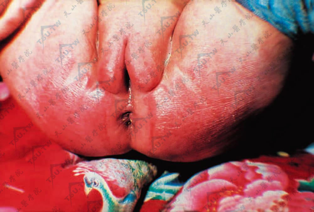 婴儿外阴部、臀部包尿布处发生红斑、丘疹性急性皮炎