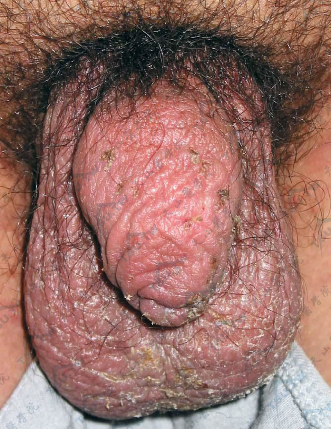 阴囊湿疹