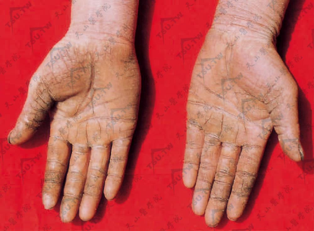 手部角化过度皲裂性湿疹