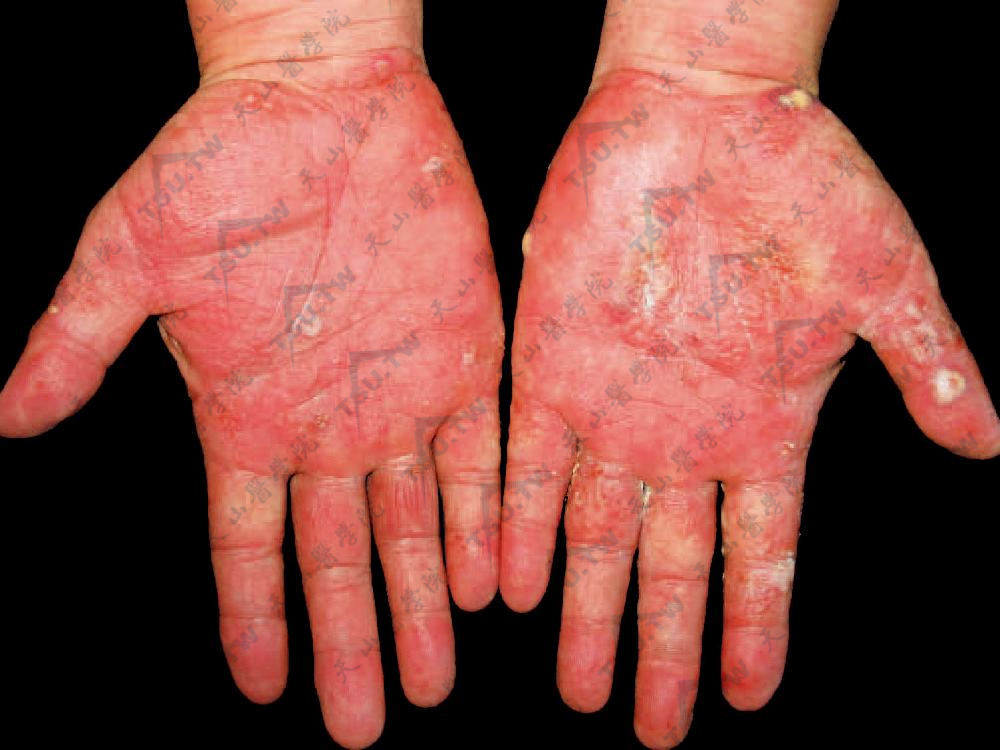  汗疱疹：手掌及手指部表皮深处的小水疱，脱屑