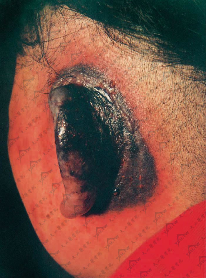 血管炎（坏死型）耳部急性肿药疹