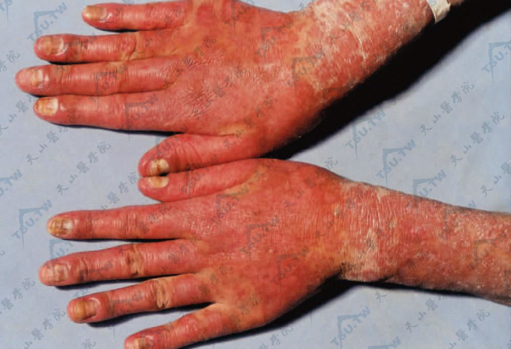 大疱性红斑狼疮　鲜红色斑，水肿性，在此损害上出现水疱或血疱