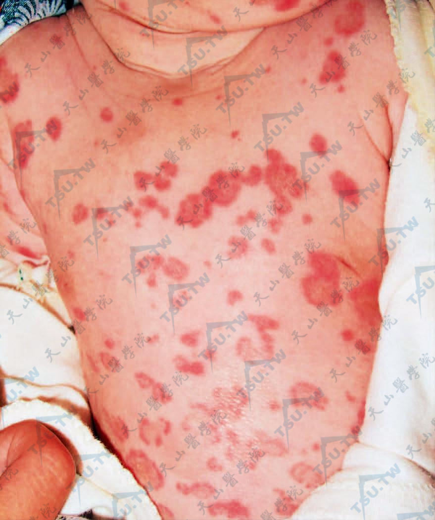 红斑狼疮：躯干部多数大小不等环状红斑，有少许鳞屑