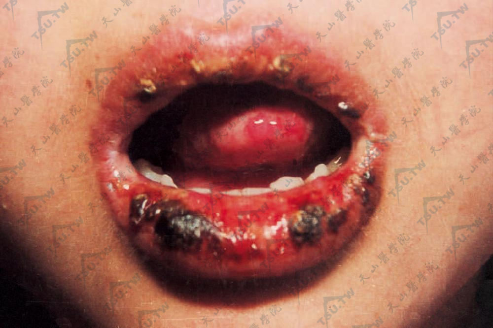 红斑狼疮：唇红部糜烂及浅溃疡，表面有结痂及血痂，下唇较明显