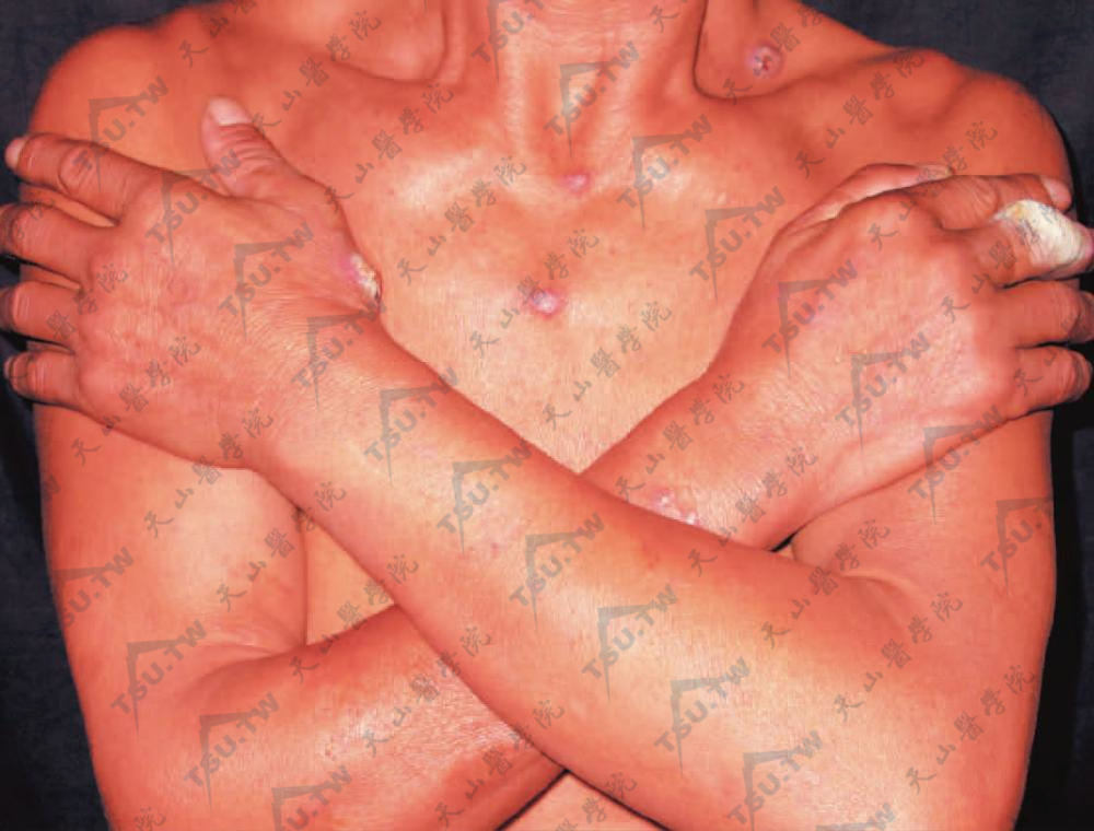 红斑狼疮症状：手臂部丘疹结节损害，皮损显著高出皮面，表面呈疣状