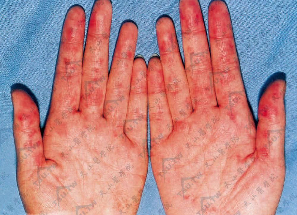指尖部鲜红色或紫红色斑点和点状出血
