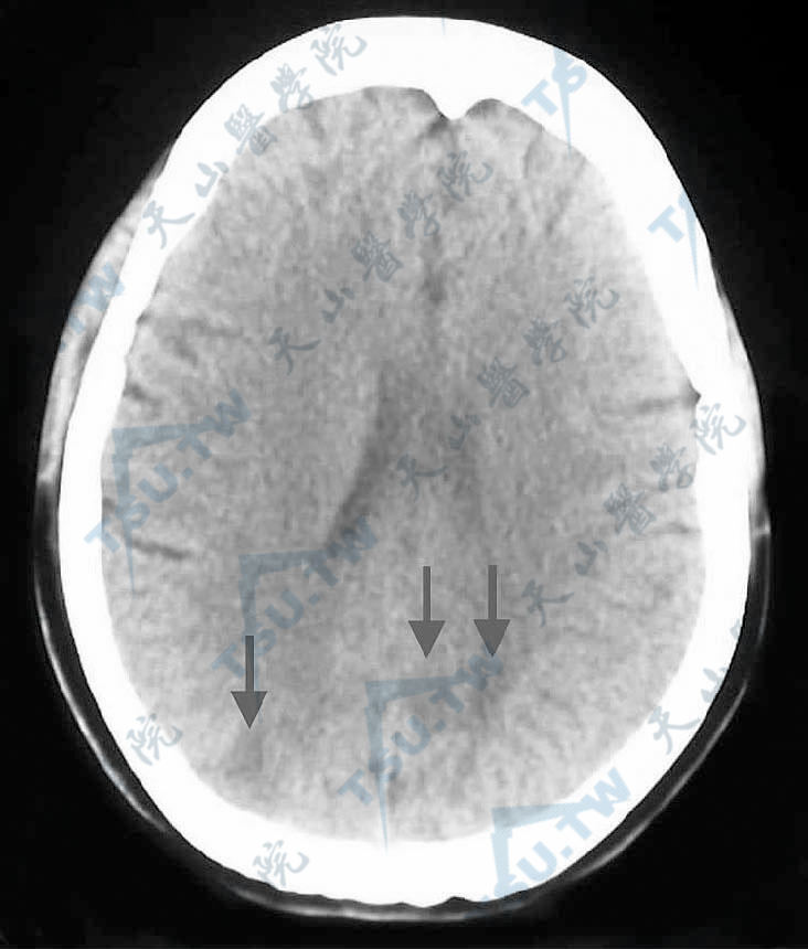神经精神性狼疮颅脑CT示枕叶皮层及皮层下多发性小片状低密度影（第四军医大学西京医院皮肤科　孙林潮提供）