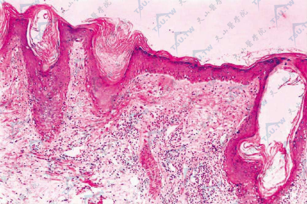 DLE组织病理毛囊角栓，表皮萎缩，血管周围淋巴细胞浸润（HE染色×100）
