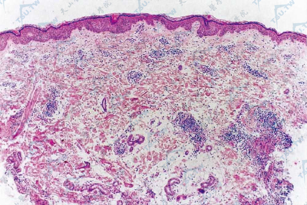 肿胀性红斑狼疮　真皮浅、深层和附属器周围有中等量淋巴细胞、组织细胞浸润（HE染色×40）（北京协和医院　马东来提供）