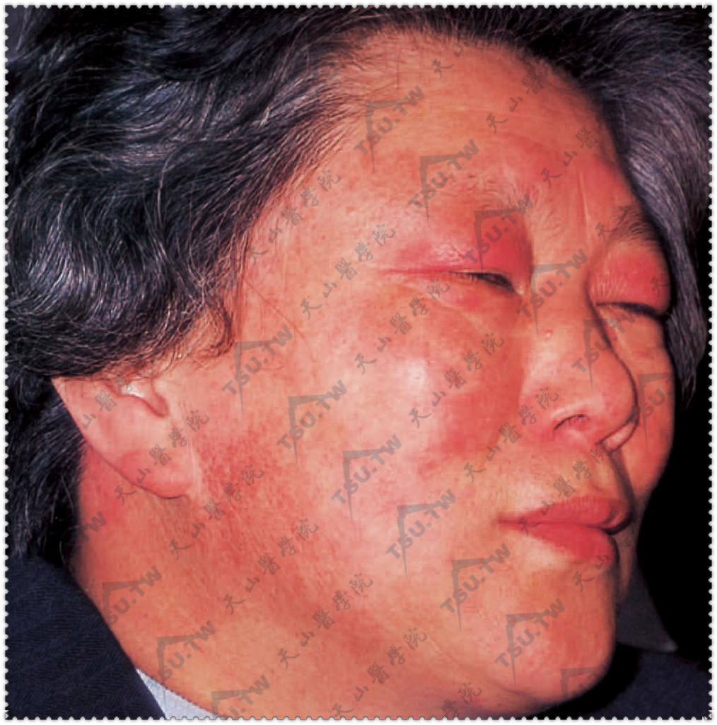 皮肌炎的早期皮损为高度特征性的对称融合的紫红色斑