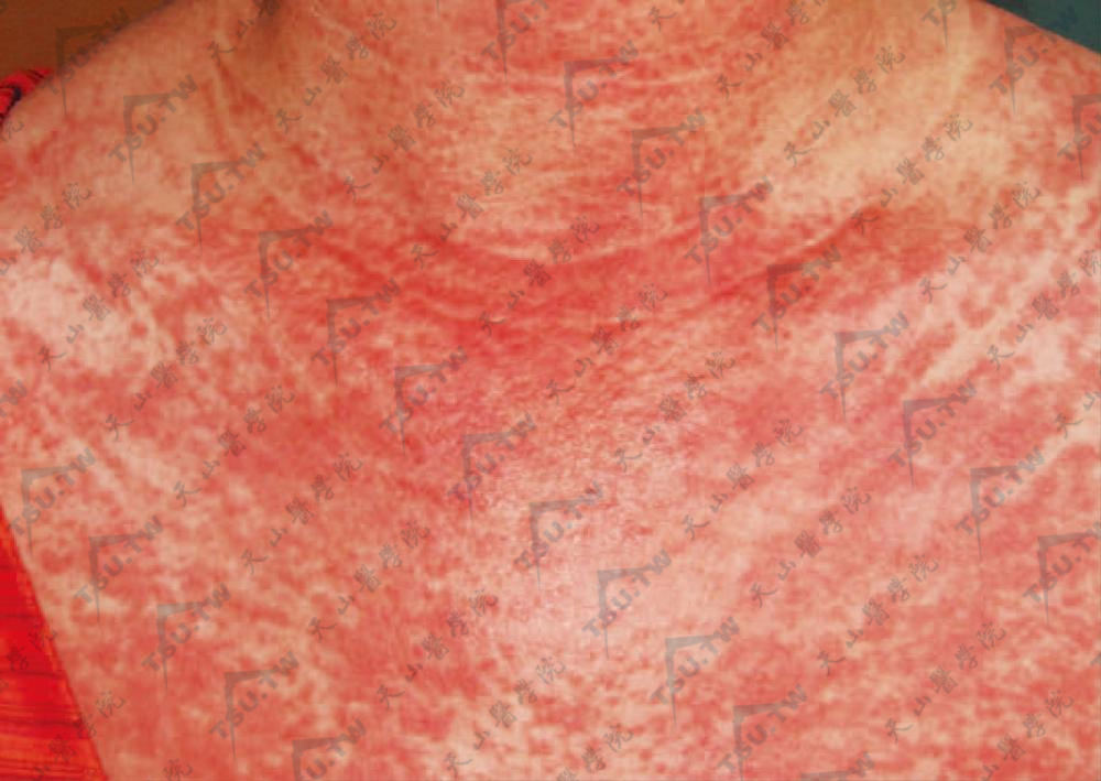 无肌病性皮肌炎　颈前三角区密集紫红色斑，呈网状