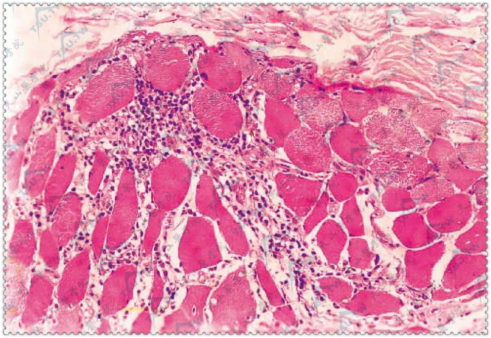 皮肌炎病理组织