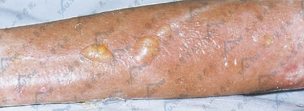 大疱性硬斑病 左上肢硬化皮肤上沿血管分布的水疱（中国医学科学院、皮肤病研究所 贾 虹提供）