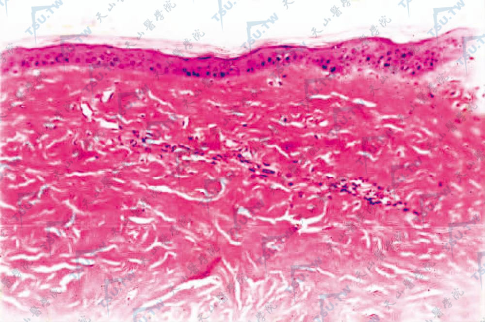 硬皮病组织病理：表皮萎缩，真皮胶原束增粗、硬化，胶原束间有少量炎细胞