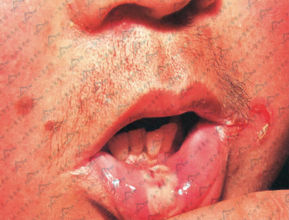 寻常型天疱疮　下唇黏膜限局性糜烂，上唇浸软发白