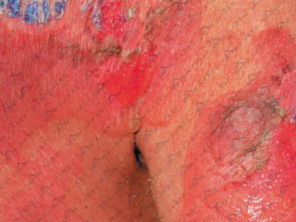 寻常型天疱疮外观正常的皮肤上出现松弛性水疱