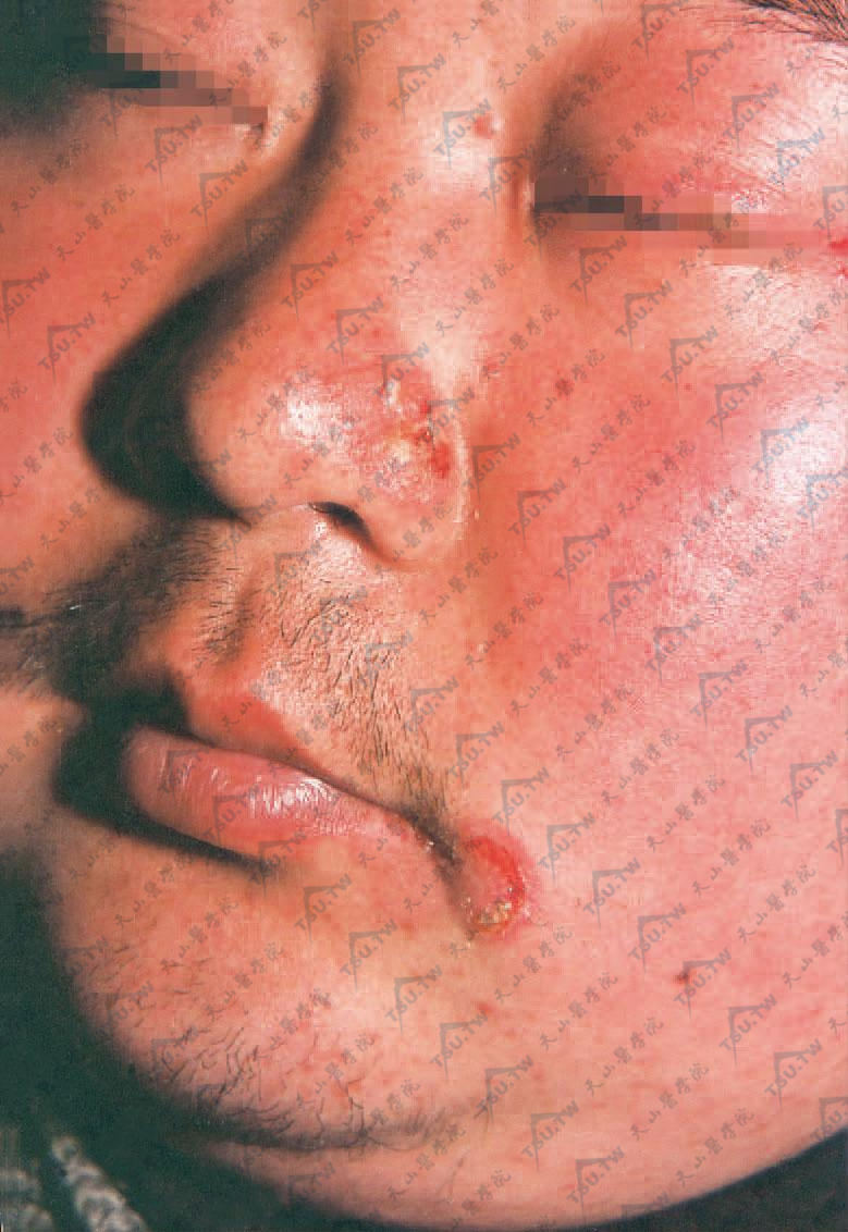 寻常型天疱疮　鼻翼及左口角部，疱破糜烂，边缘附着疱壁