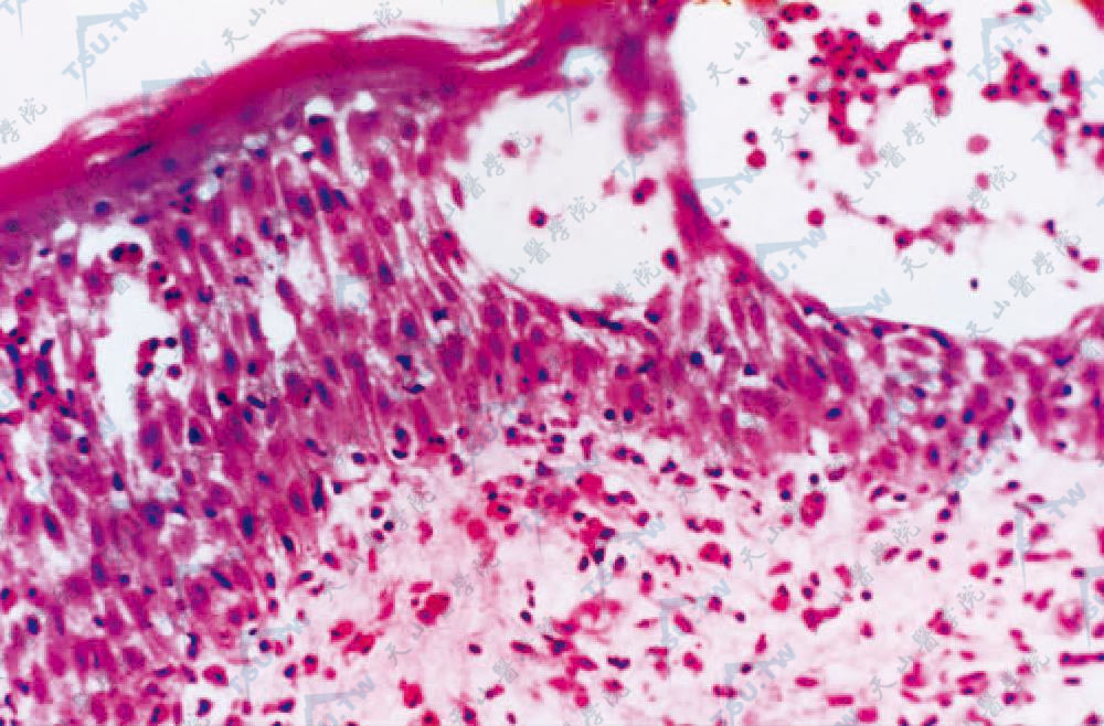 疱疹样天疱疮：棘层中部海绵形成性水疱，多数嗜酸性粒细胞浸润