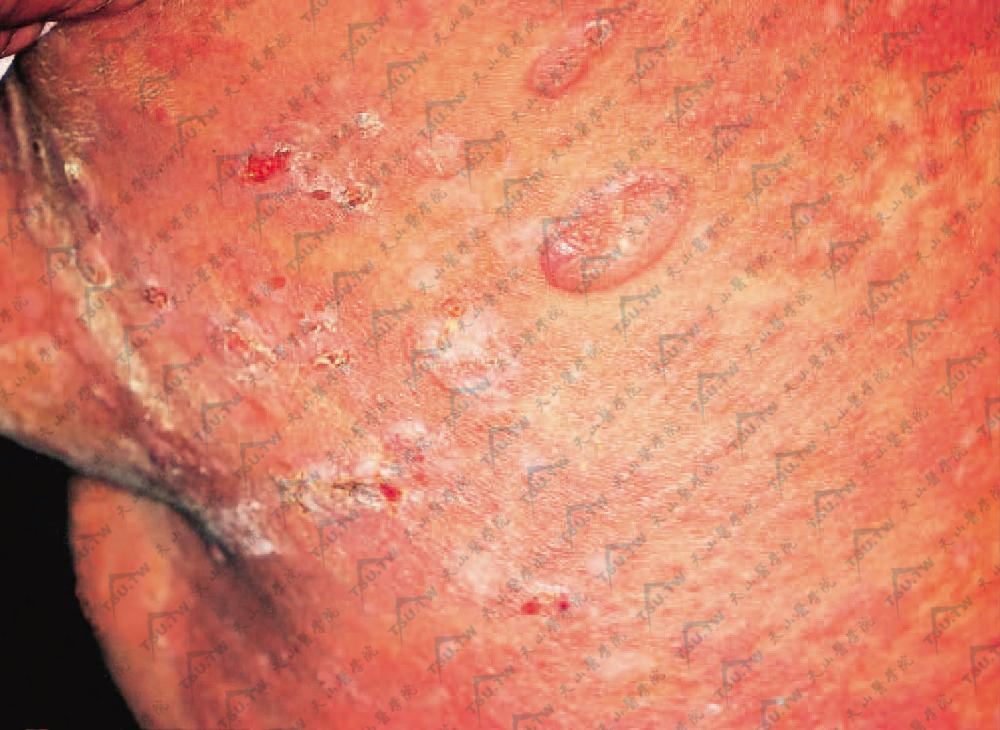 副肿瘤性天疱疮症状：背部红斑、水疱及大疱