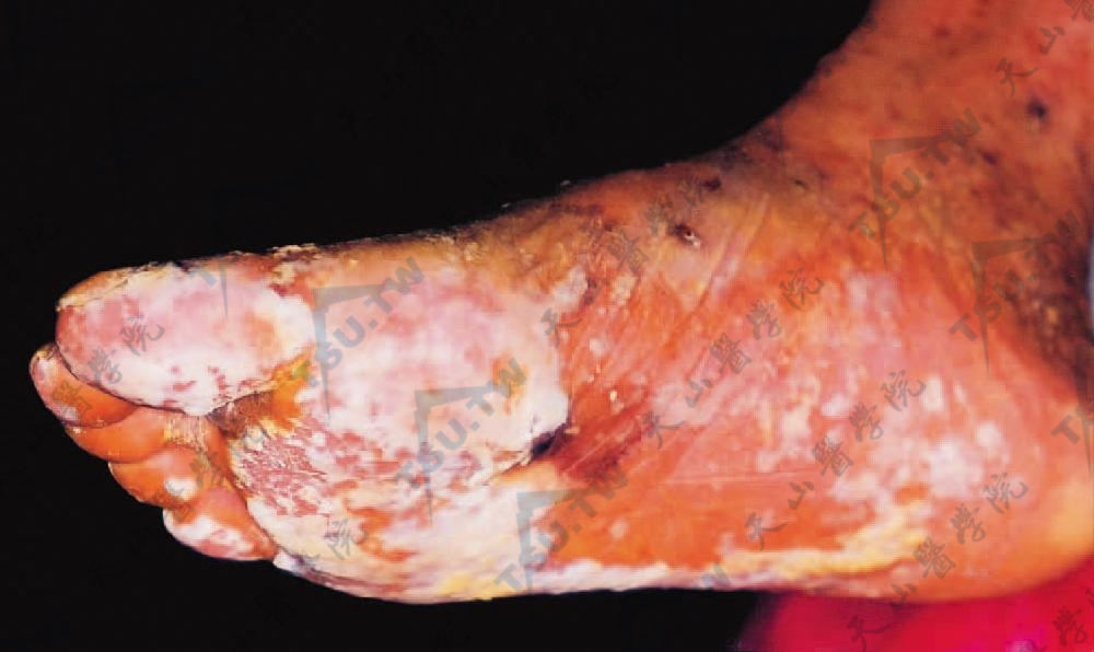 副肿瘤性天疱疮症状：足跖部水肿性红斑、水疱及糜烂