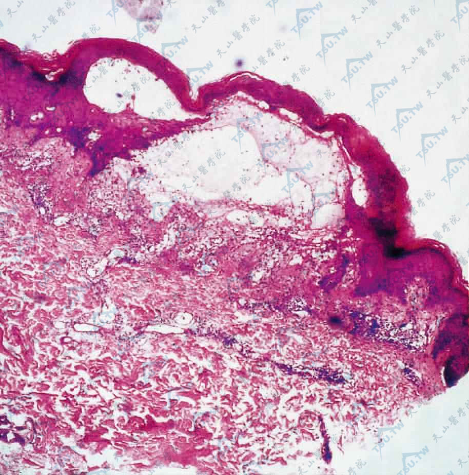 组织病理检查，见表皮下大疱