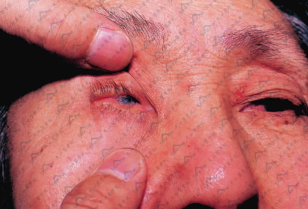 瘢痕性类天疱疮　眼结膜红斑糜烂，瘢痕导致睑、球结膜粘连