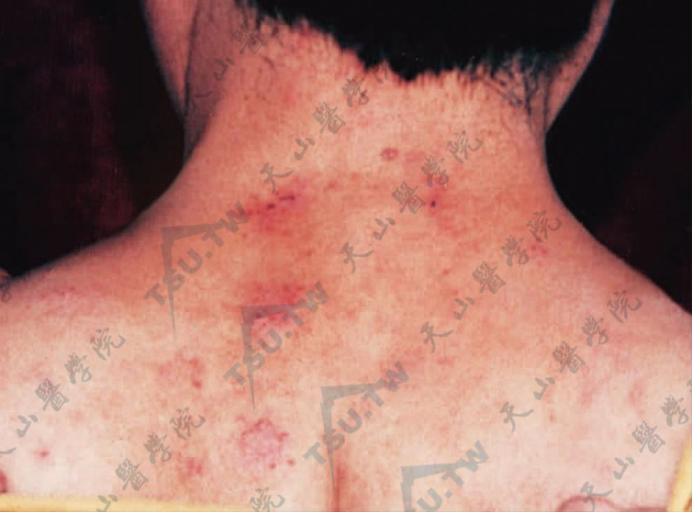 背上部散在或密集、红棕色水肿性丘疹及丘疱疹