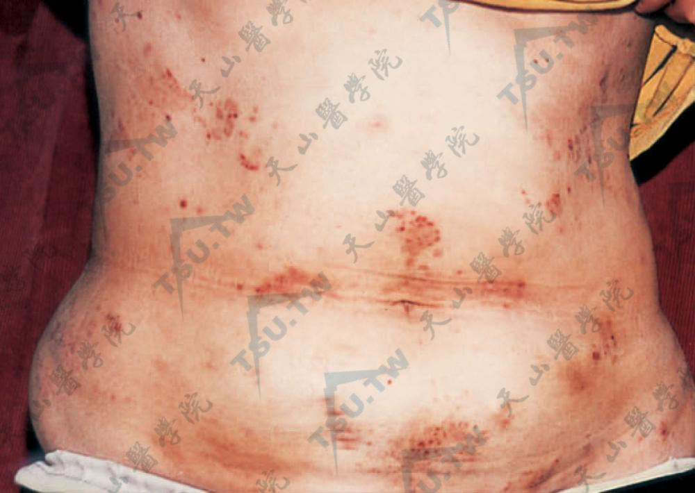 腹部散在或密集、红棕色水肿性丘疹及疱疹