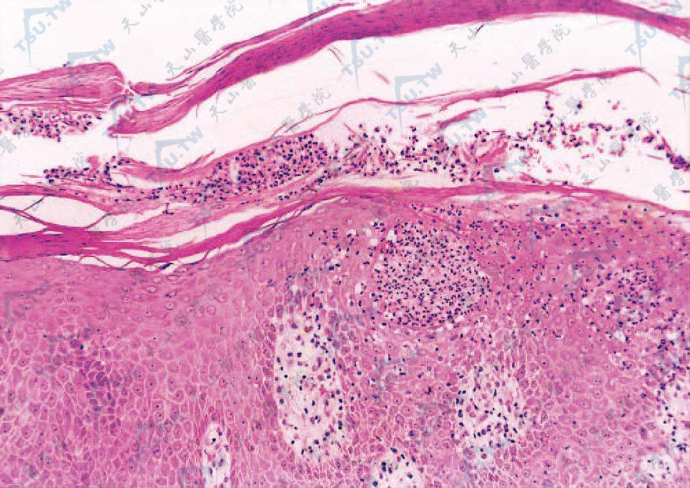 角层下脓疱性皮病组织病理