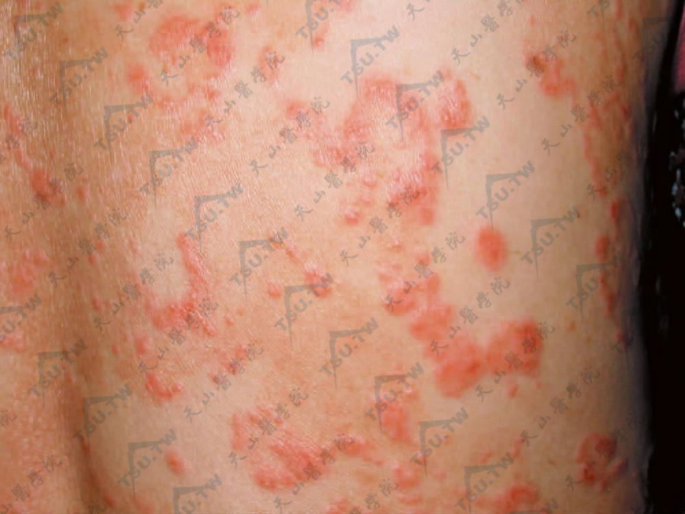 毛囊性丘疹，顶端常有脓疱