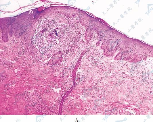 嗜酸性脓疱性毛囊炎组织病理