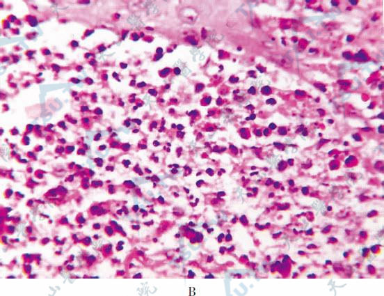 毛囊内脓疱形成，内含大量嗜酸性粒细胞和中性粒细胞