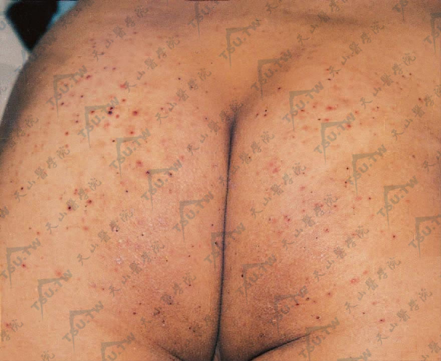 变应性皮肤血管炎症状：臀部多数紫癜样斑丘疹