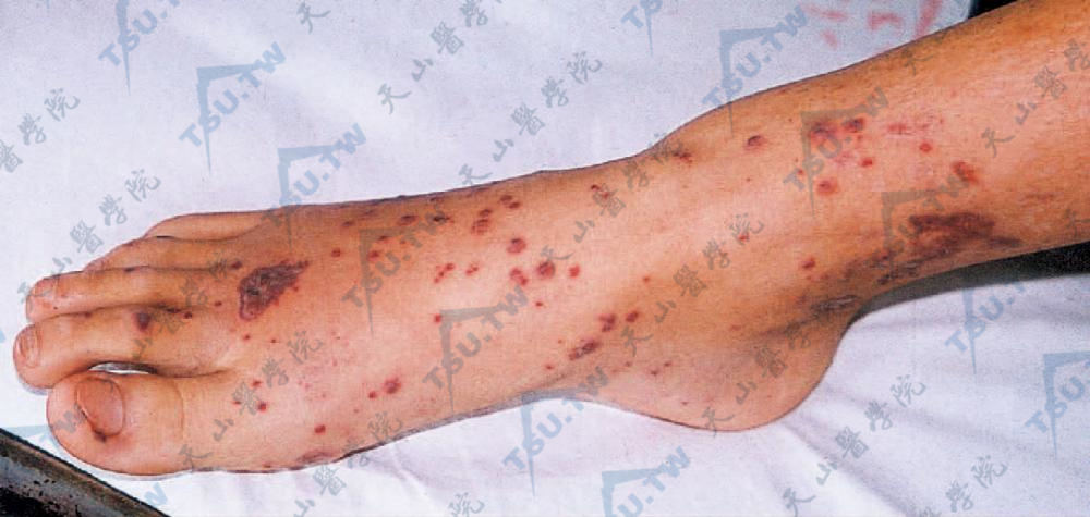 变应性皮肤血管炎症状：足部及小腿下方多数紫癜样斑丘疹