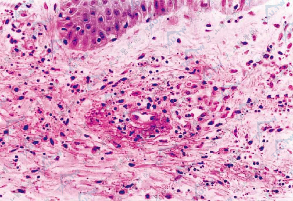 变应性皮肤血管炎症状组织病理：小血管壁纤维蛋白样变性，中性核碎裂（核尘），少量红细胞外溢