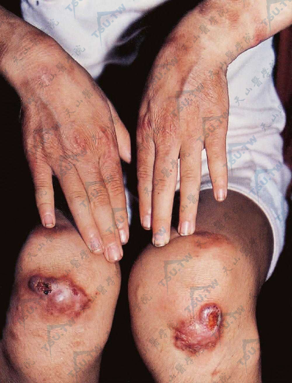 膝关节伸侧暗红色斑块，周围散在红色丘疹