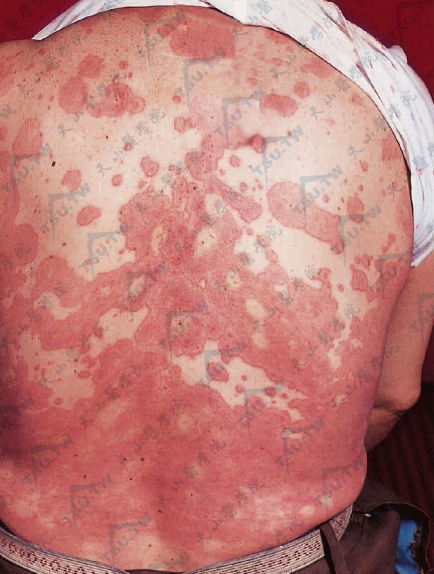 荨麻疹性血管炎症状：背部多数鲜红色风团，触之有浸润感，有的损害中见点状出血，消退处有色素沉着