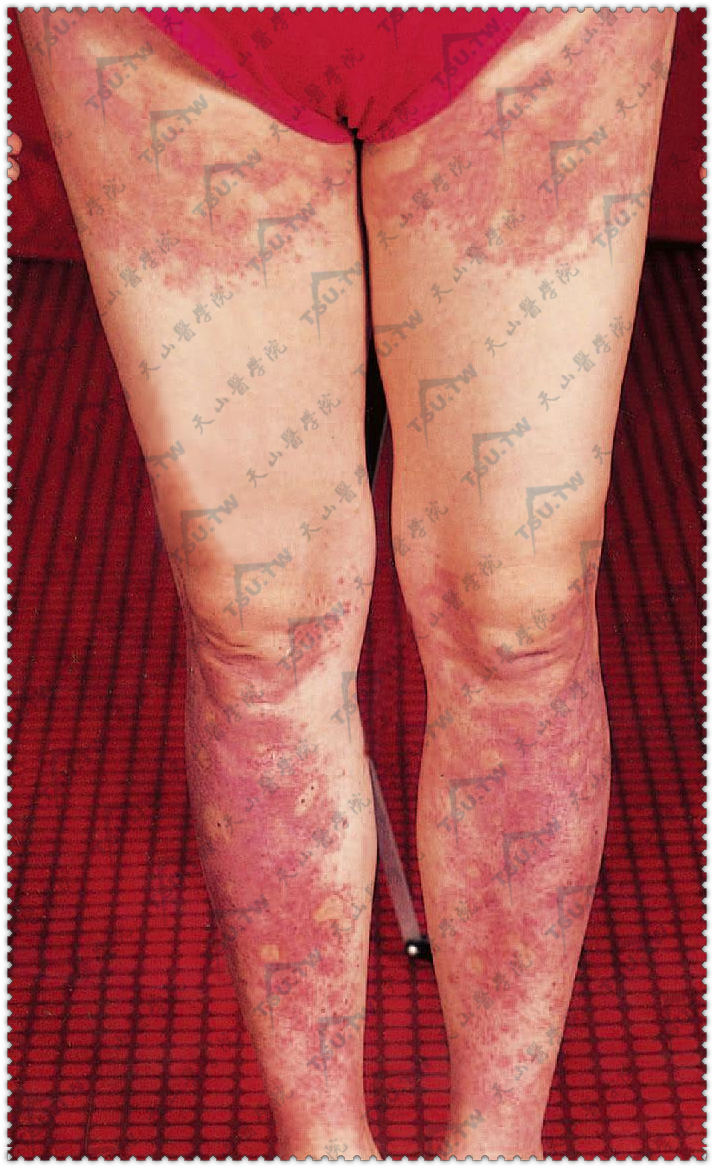 荨麻疹性血管炎症状：腿部有多数鲜红色风团损害