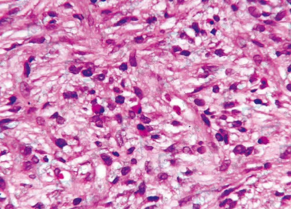 局部可见较多嗜酸性粒细胞和浆细胞浸润（HE染色×400）（北京协和医院　李军提供）