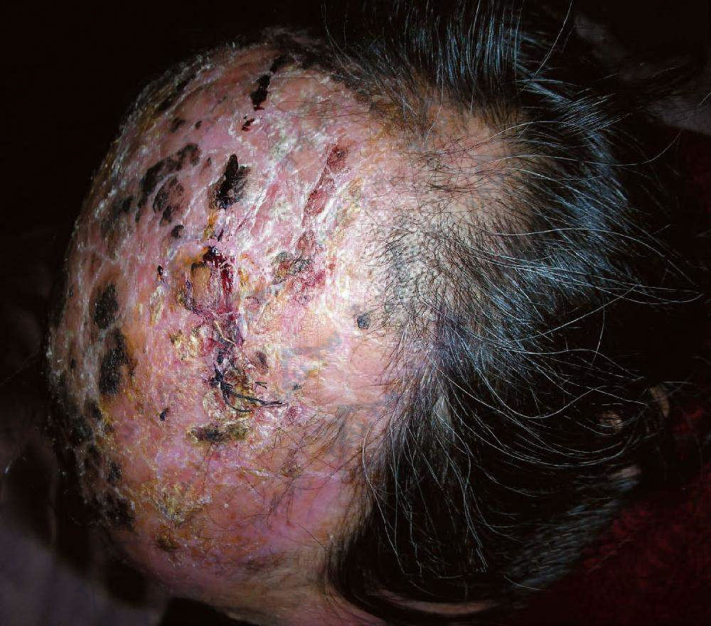 患者头顶及额部头皮因颞动脉炎，局部坏死、结痂，头发大片脱落