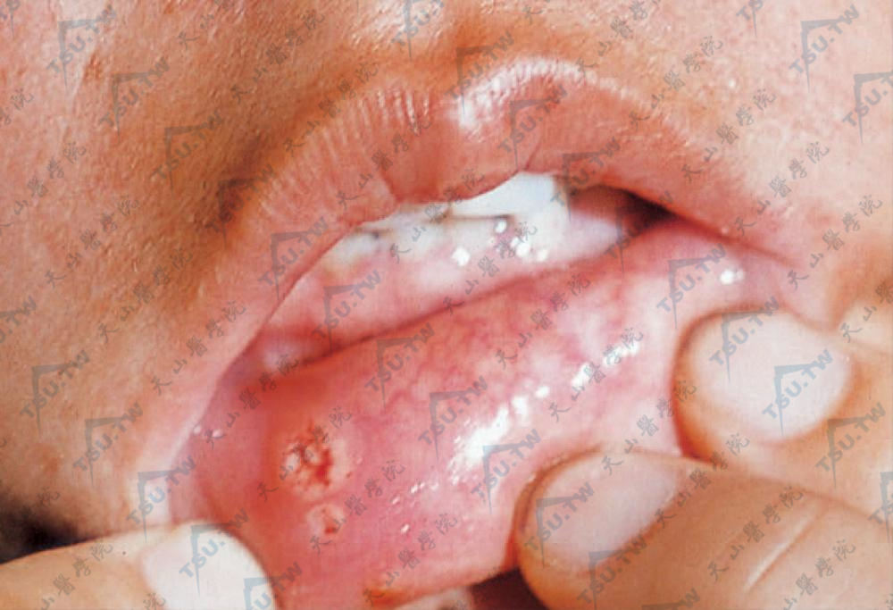 白塞病：下唇内多发性溃疡，圆形或橢圆形，中央有淡黄色坏死基底，周围有红晕