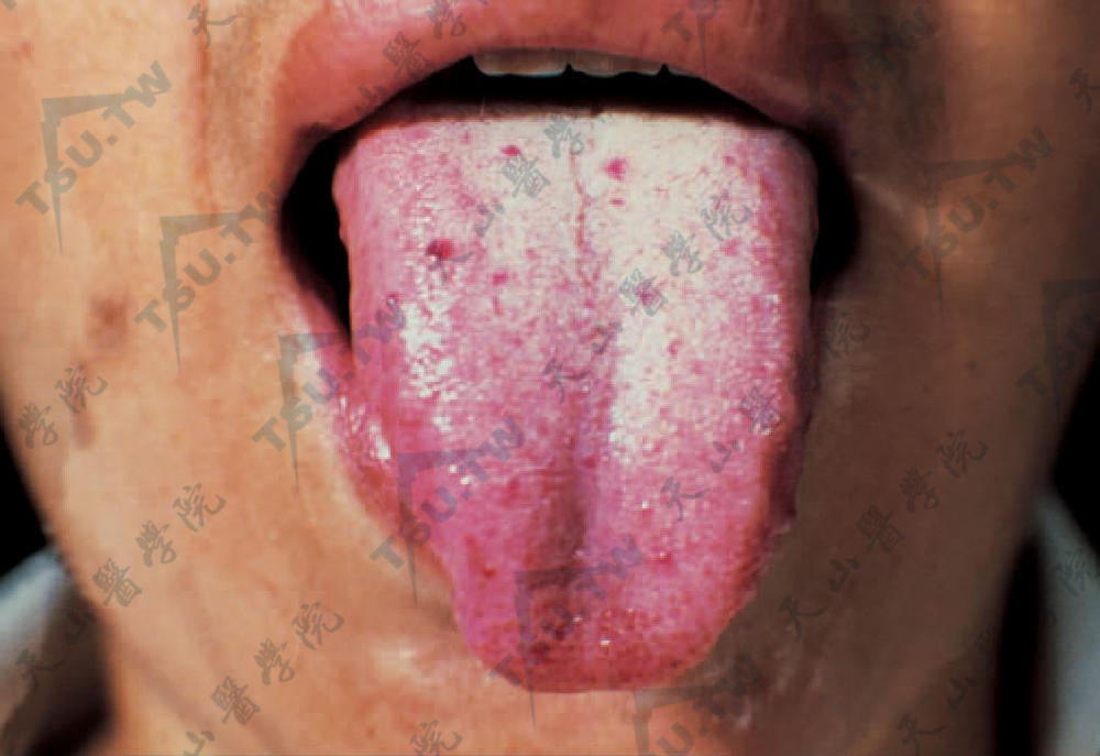 遗传性出血性毛细血管扩张症舌头症状